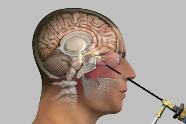 Brain Surgery through Nasal Route with No Incision