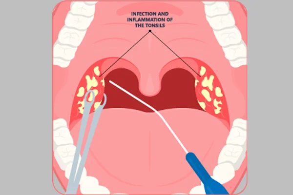 Removal of Tonsil in Bloodless Way