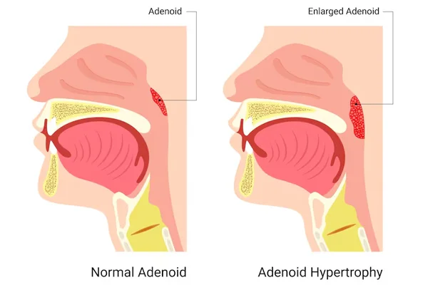 Child Relief and Growth Resume From Hypertrophic Adenoids